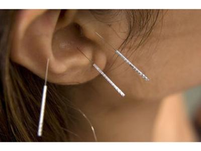 Quit-Smoking-Acupuncture