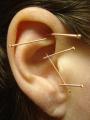 Quit Smoking With Acupuncture