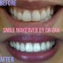 Teeth Whitening
