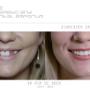 smile makeover