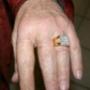 Silicone Index Finger, After
