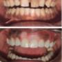 Resin Composite Veneers