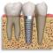 Implants available at excellent rates. Call for a quote!