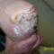 PRESSURE ULCER ON HEAL