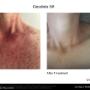 Anti agein results