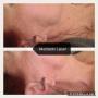 Non surgical neck lift