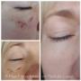 Pigmentation results