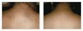 Laser hair removal