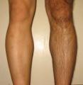 IPL permanent hair removal