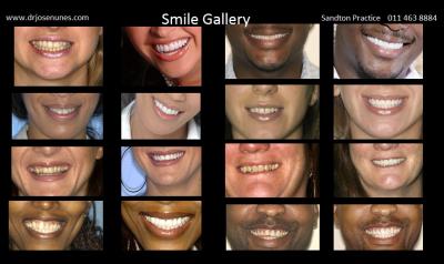 Dental-Crown-is-R4000-inc