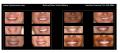 Cost Of Dental Implants