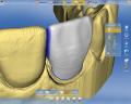 Cerec Ceramic Crowns, Veneers and Fillings