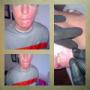 Client with skin cancer scars - Dry skin needling