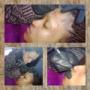 Facial scarring - skin needling
