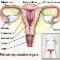 Womb-Cleaning