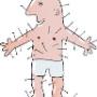 Acupuncture