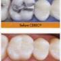 CEREC ceramic fillings