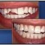 Composite Bonding
