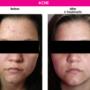 Acne reduction