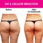 Fat and Cellulite Reduction