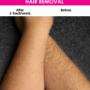 Hair removal