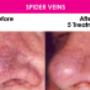Reduction of Spider Veins