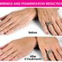 Reduction of pigmentation
