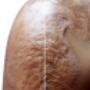 Skin rejuvenation