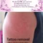 Tattoo removal 2