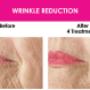 Wrinkle reduction