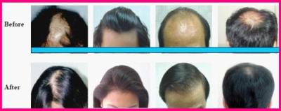 Laser-Hair-re-growth