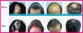 Laser Hair re-growth treatments now available at LASER LIPO HOUSE!
