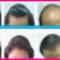 Laser-Hair-re-growth