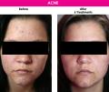 Reduction of Acne