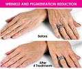 Reduction of Pigmentation