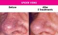 Reduction of Spider Veins