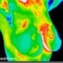 Breast CA 1