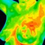 Breast ca 2