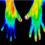 Neuropathy