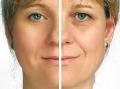 RF (Radio Frequency) Wrinkle Reduction