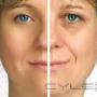 Uploaded by visitor on 2016/01/25 - RF (Radio Frequency) Wrinkle Reduction