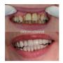 Smile Makeover 1