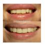 Smile Makeover 2