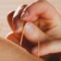 Dry Needling