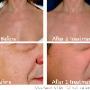 UV Aesthetics - Ellipse skin rejuvination - Cape T