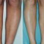 UV Aesthetics - Permanent Hair Removal - Cape Town