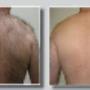 UV Aesthetics - Permanent Hair Removal - Cape Town