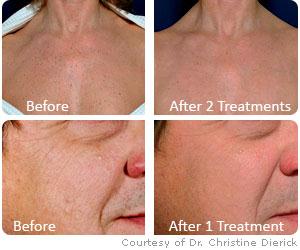 Ellipse-Skin-Rejuvenation