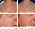 IPL Skin Rejuvenation