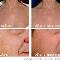 Ellipse-Skin-Rejuvenation